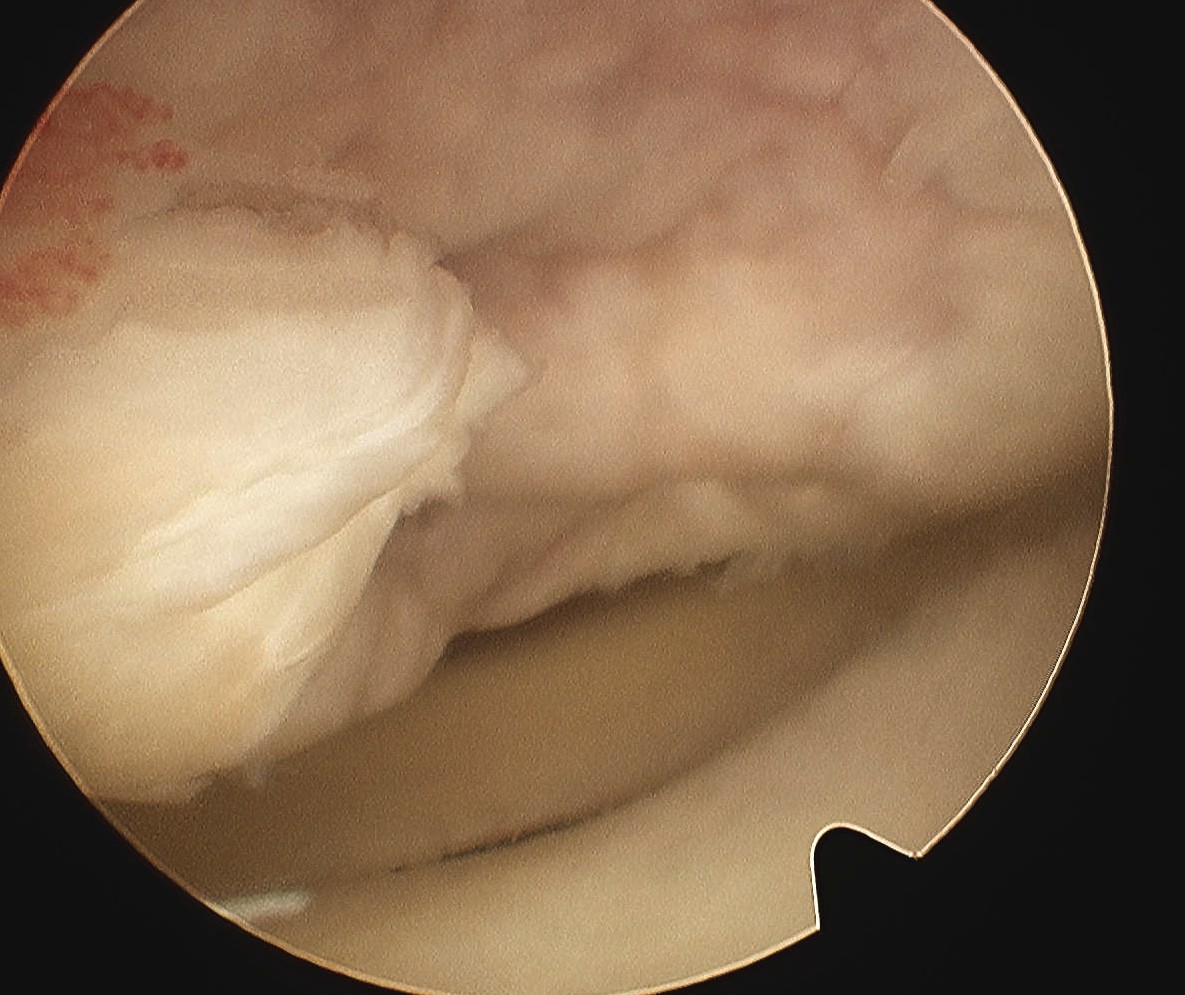 Knee OCD Arthroscopy Type 4